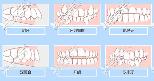 需要牙齿矫正的牙齿