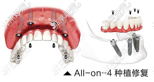 All-on-4全口種植牙示意圖