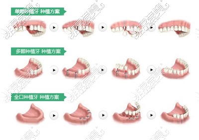 不同数量种植牙方案示意图