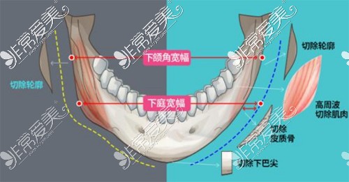 不同术式的下颌角整形