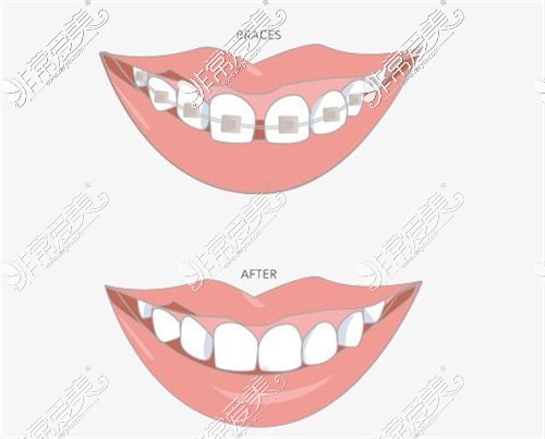 牙齿矫正卡通图