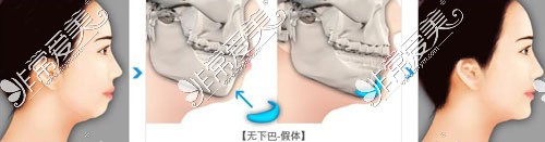 成都军大整形医院做下巴手术过程