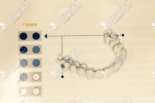 隐适美矫正依从指示器