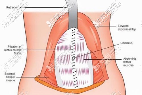 腹壁整形手术示意图