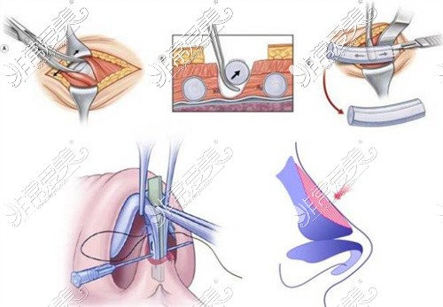 內(nèi)江達芬奇隆鼻手術(shù)示意圖
