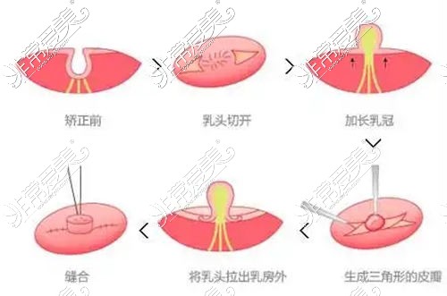 乳頭內陷矯正手術過程