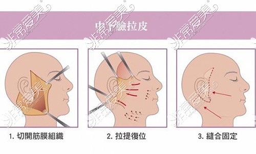 买不拉皮手术步骤示意图