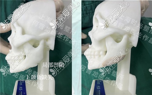 上海时光整形外科下颌角修复