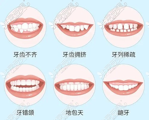 需要矯正的牙齒情況