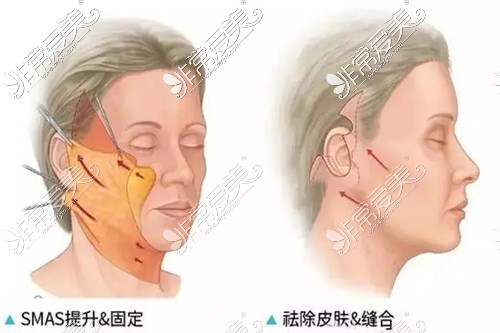 贵阳拉皮除皱手术的价格一般是多少?详细地址和价格都有哦