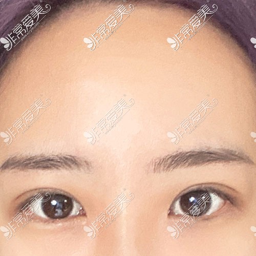 韩国yellow双眼皮手术恢复照
