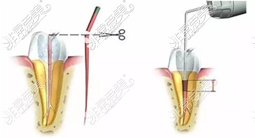 根管治疗示意图