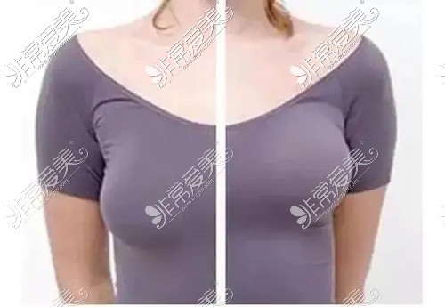 乳房增大扩大图片