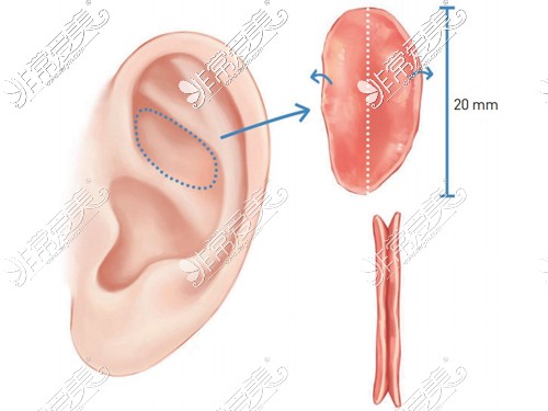 耳软骨隆鼻取出部位