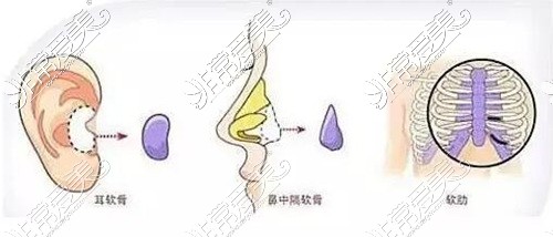 自體軟骨隆鼻常用材料