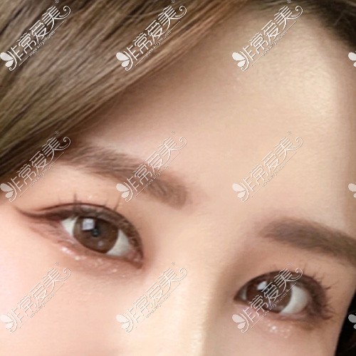 韩国yellow双眼皮术后图