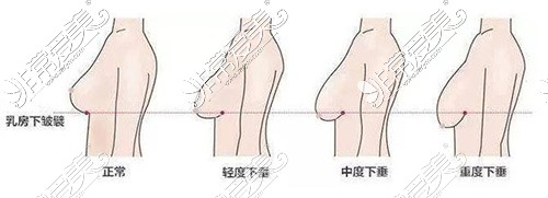 南京胸下垂矫正哪些医院做比较好 胸下垂要多少钱一起康康