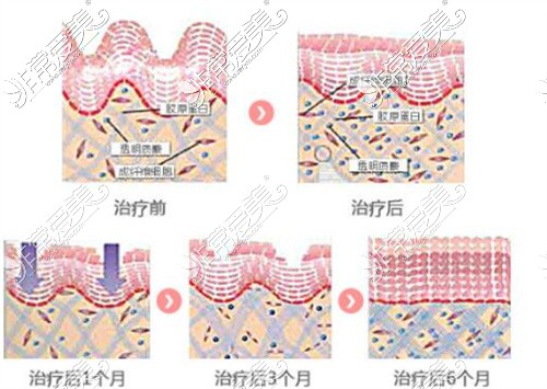 熱瑪吉皮膚對比圖