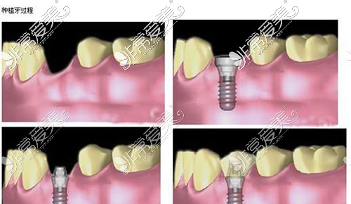 种植牙过程示意图
