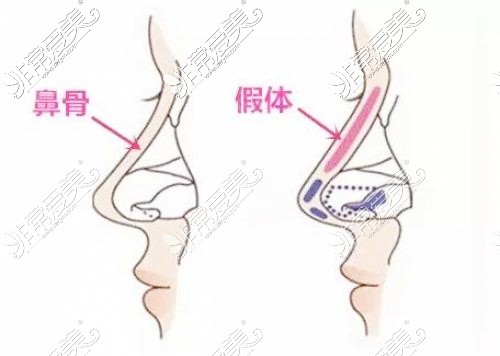 假体隆鼻卡通图示