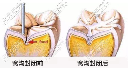 窝沟封闭治疗