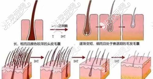 植發(fā)過程示意圖