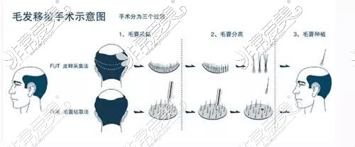 毛发移植示意图