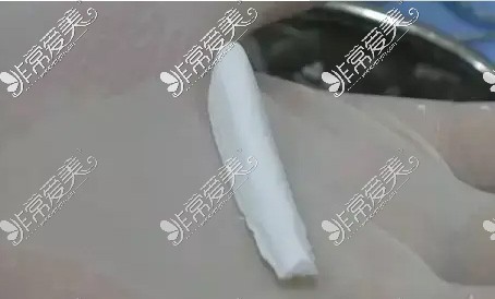 隆鼻假體照片