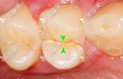 牙隐裂照片