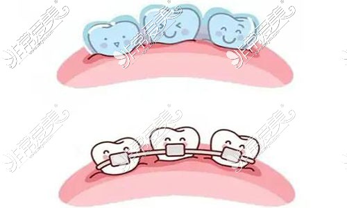 金属矫正和隐形矫正