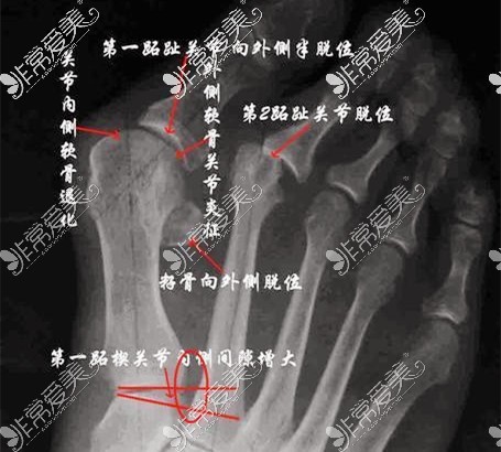 大脚骨X光片图示