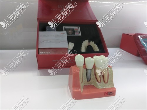重庆团圆口腔医院种植牙模型展示图