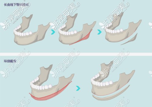 不同的下颌角整形术式