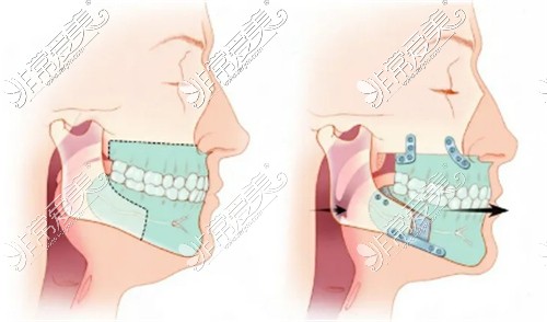 正颌手术动画展示图