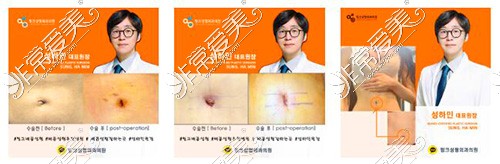 韩国link整形肚脐手术照片