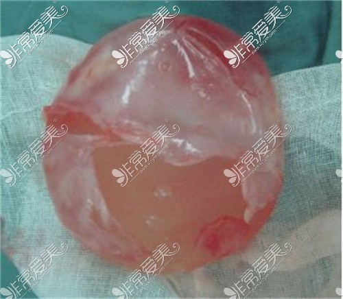 假体隆胸包膜挛缩图片图片