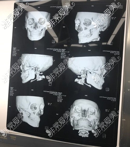 术前脸骨X光片