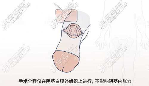 男性陰莖增粗生物補(bǔ)片植入位置漫畫圖