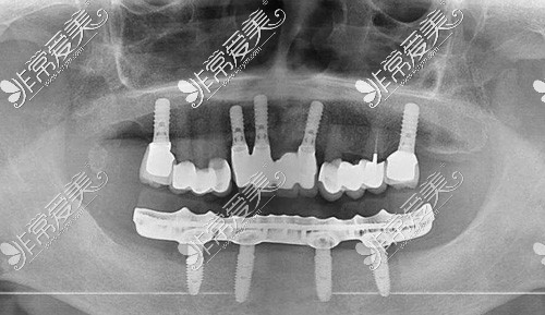 全口种植牙术后ct照