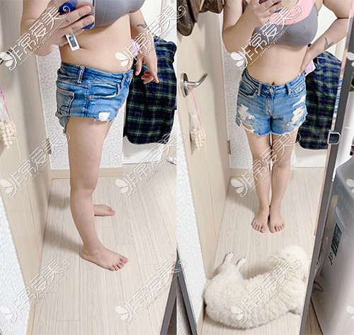 韩国wiz美大腿吸脂术后两个月