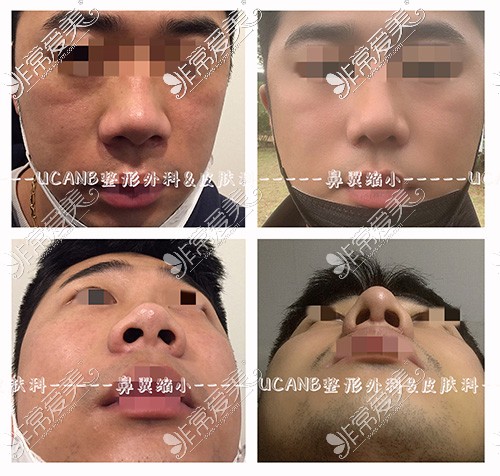 韩国Ucanb整形鼻翼缩小手术对比照