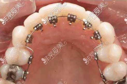 舌側(cè)牙齒矯正示意圖