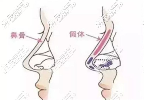 假體隆鼻示意圖