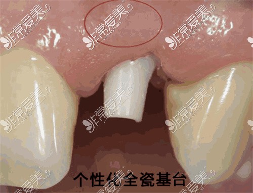 種植體瓷基臺