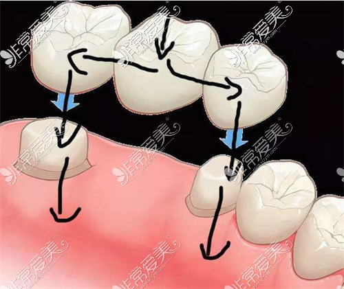 种植美学临时修复