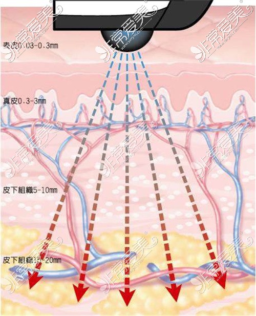 fotona提升示意图