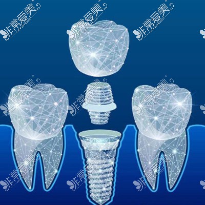 种植牙图片