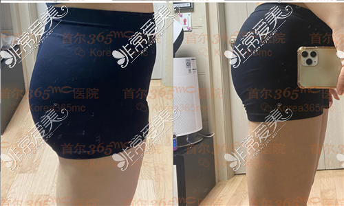 韩国365mc吸脂医院近来主打的蜂腰肥臀项目是真的吗