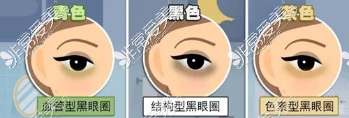 贵阳去黑眼圈眼袋手术多少钱?黑眼圈手术眼袋手术价格分享