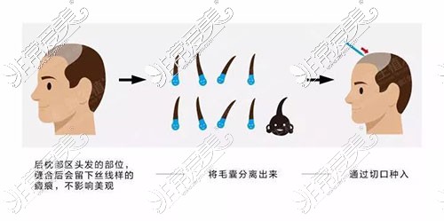 植发手术过程示意图